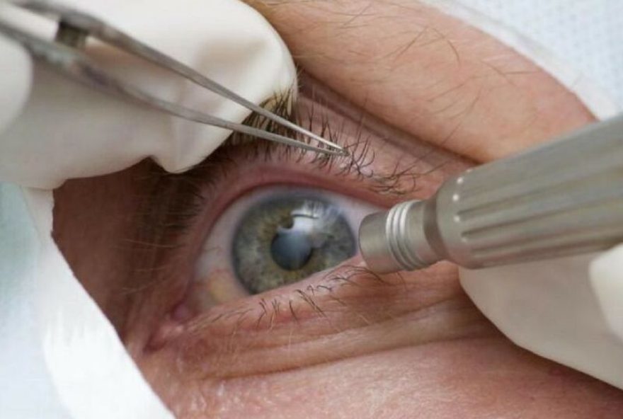 lula-passa-por-cirurgia-de-catarata3A-saiba-mais-sobre-a-doenca-e-o-procedimento lula-passa-por-cirurgia-de-catarata3A-saiba-mais-sobre-a-doenca-e-o-procedimento