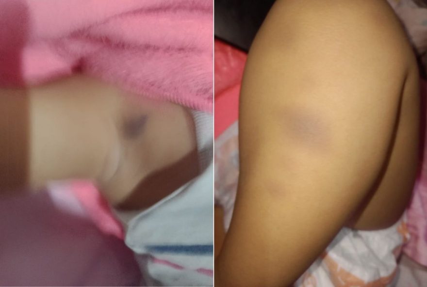 mae-denuncia-agressoes-em-creche-de-praia-grande3A-bebe-volta-com-hematomas