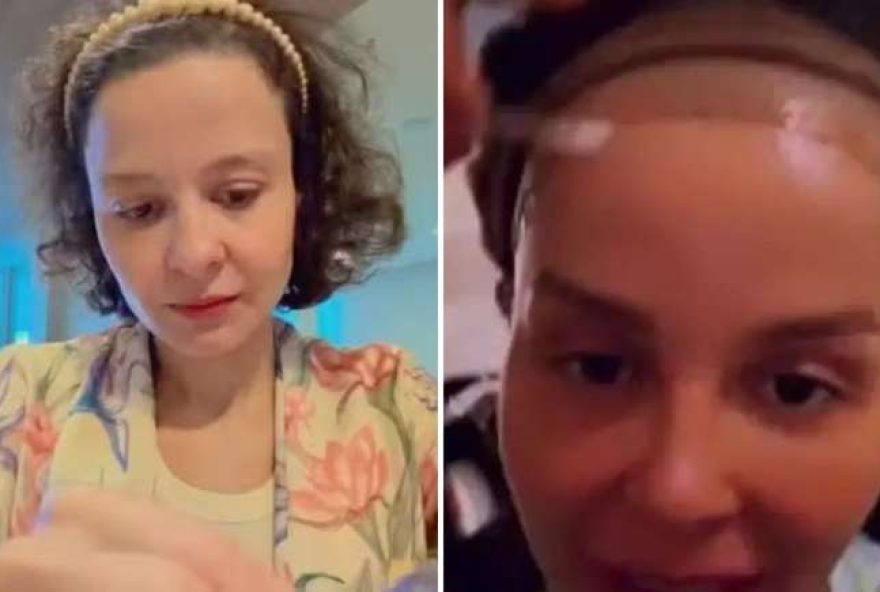 maiara2C-da-dupla-maiara-e-maraisa2C-fala-sobre-alopecia-androgenetica3A-causas2C-sintomas-e-tratamentos.-como-lidar-com-a-perda-de-cabelo maiara2C-da-dupla-maiara-e-maraisa2C-fala-sobre-alopecia-androgenetica3A-causas2C-sintomas-e-tratamentos.-como-lidar-com-a-perda-de-cabelo