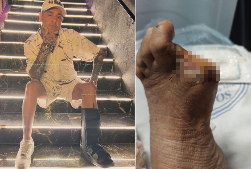 mc-danilo-boladao3A-amputacao-do-dedao-do-pe-por-complicacoes-de-diabetes mc-danilo-boladao3A-amputacao-do-dedao-do-pe-por-complicacoes-de-diabetes