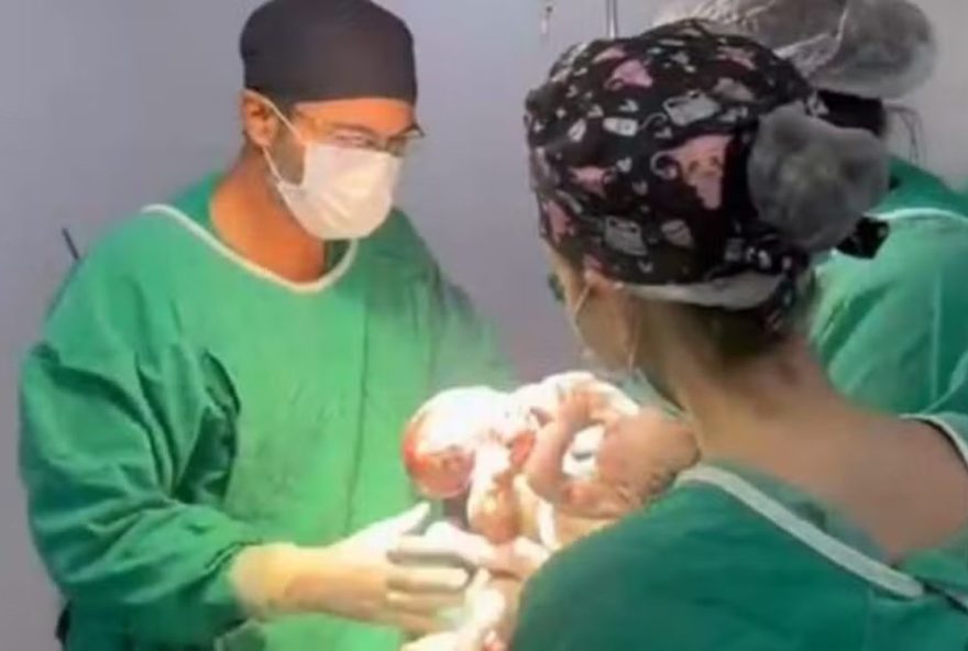 medico-destaca-importancia-de-salvar-vidas-em-caso-de-gemeos-siameses medico-destaca-importancia-de-salvar-vidas-em-caso-de-gemeos-siameses