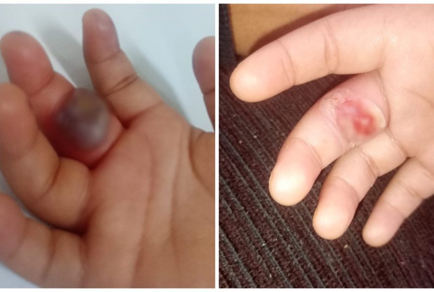 menina-de-2-anos-tem-dedo-ferido-apos-picada-de-aranha-em-sorocaba3A-mae-suspeita-da-creche menina-de-2-anos-tem-dedo-ferido-apos-picada-de-aranha-em-sorocaba3A-mae-suspeita-da-creche