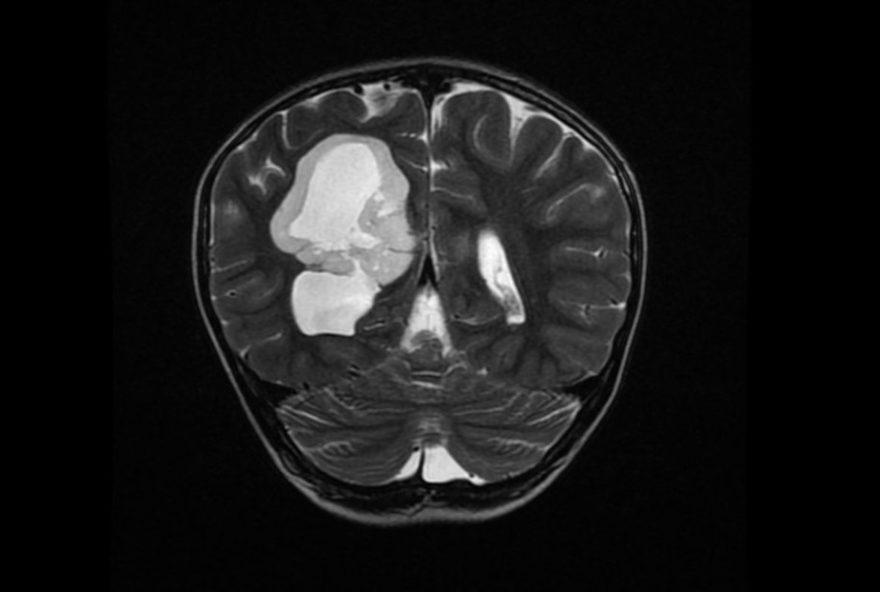 menino-atropelado-descobre-tumor-no-cerebro-e-toca-sino-da-vitoria-em-luta-contra-o-cancer menino-atropelado-descobre-tumor-no-cerebro-e-toca-sino-da-vitoria-em-luta-contra-o-cancer
