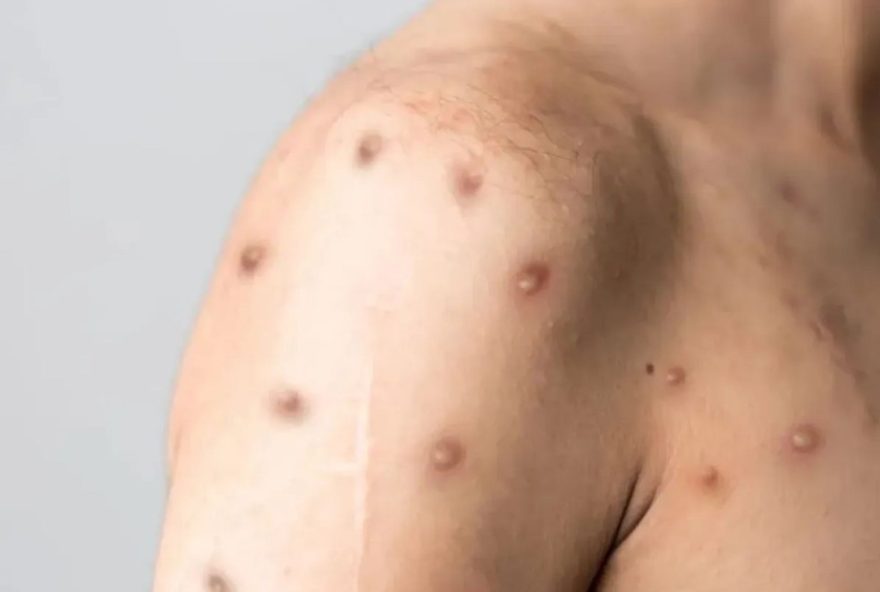 minas-gerais-confirma-5o-caso-de-mpox-em-20263A-entenda-por-que-a-doenca-e-uma-emergencia-global minas-gerais-confirma-5o-caso-de-mpox-em-20263A-entenda-por-que-a-doenca-e-uma-emergencia-global