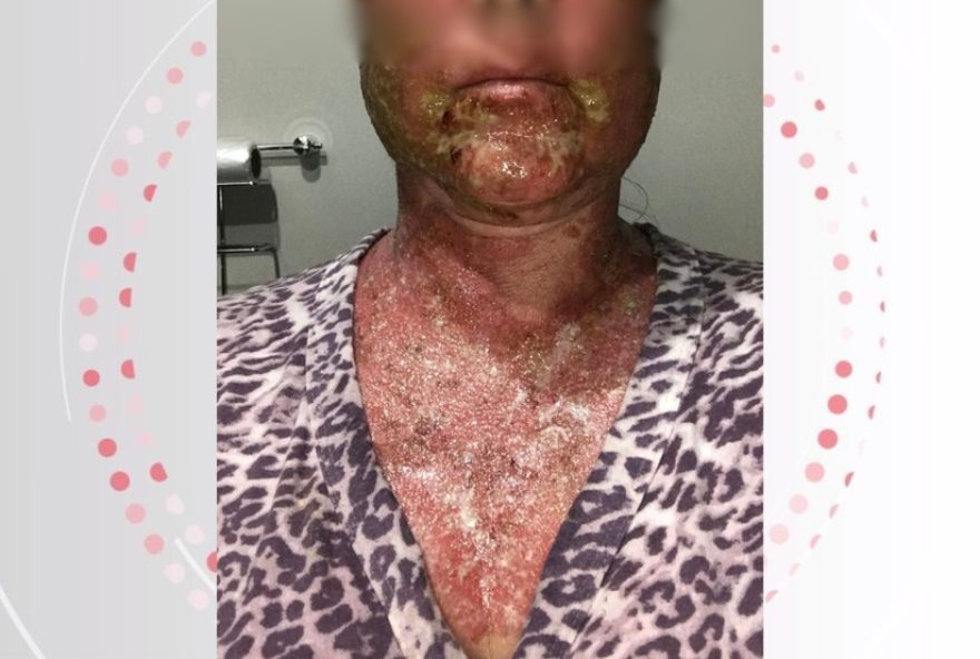 mulher-e-indenizada-em-r24-125-mil-por-queimaduras-graves-apos-peeling-em-clinica-no-parana mulher-e-indenizada-em-r24-125-mil-por-queimaduras-graves-apos-peeling-em-clinica-no-parana