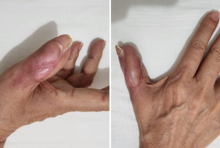 mulher-perde-parte-do-dedo3A-tratamento-inclui-cirurgias-e-fisioterapia