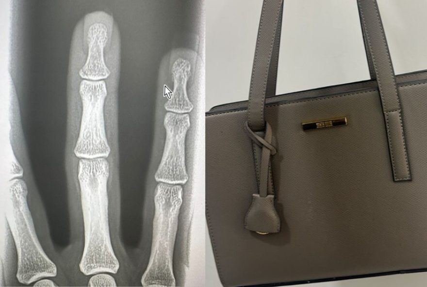 mulher-quebra-dedo-em-perseguicao-a-assaltante-e-recupera-bolsa-em-mg
