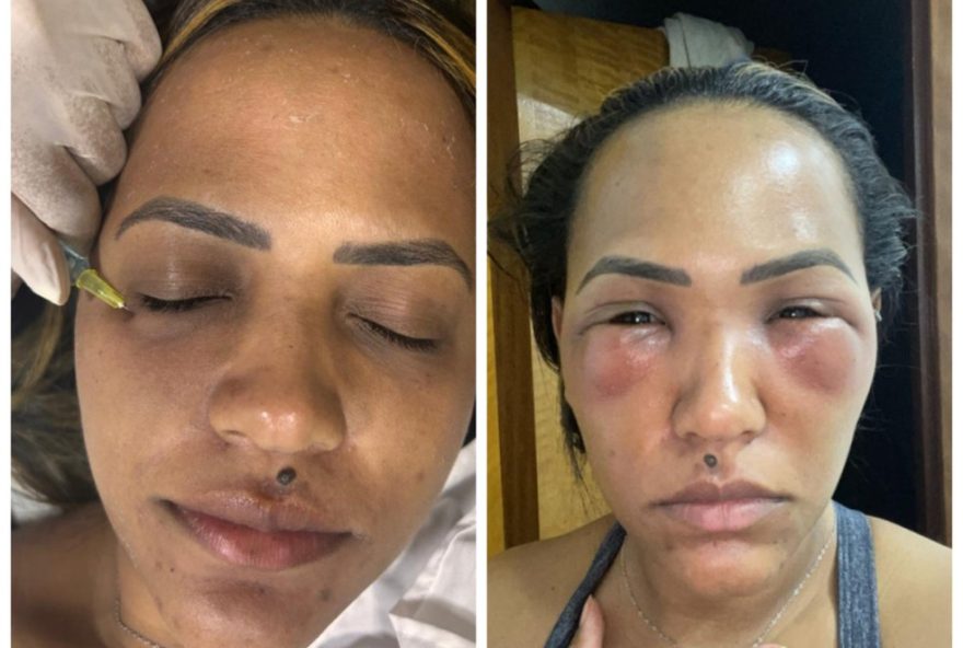 mulher-tem-olhos-inchados-e-roxos-apos-preenchimento3A-22desejo-de-melhorar-autoestima-virou-problema22