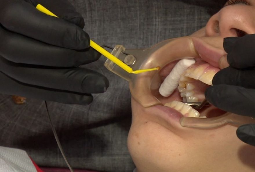 nanoparticulas-de-prata3A-solucao-indolor-para-carie-sem-motorzinho nanoparticulas-de-prata3A-solucao-indolor-para-carie-sem-motorzinho