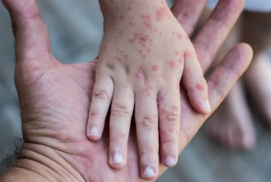 Doença pode causar manchas pelo corpo. (Foto: Reprodução/Tua Saúde)