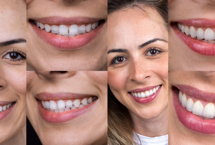 santos3A-sorrisos-naturais-com-lentes-e-implantes-de-classe-mundial santos3A-sorrisos-naturais-com-lentes-e-implantes-de-classe-mundial