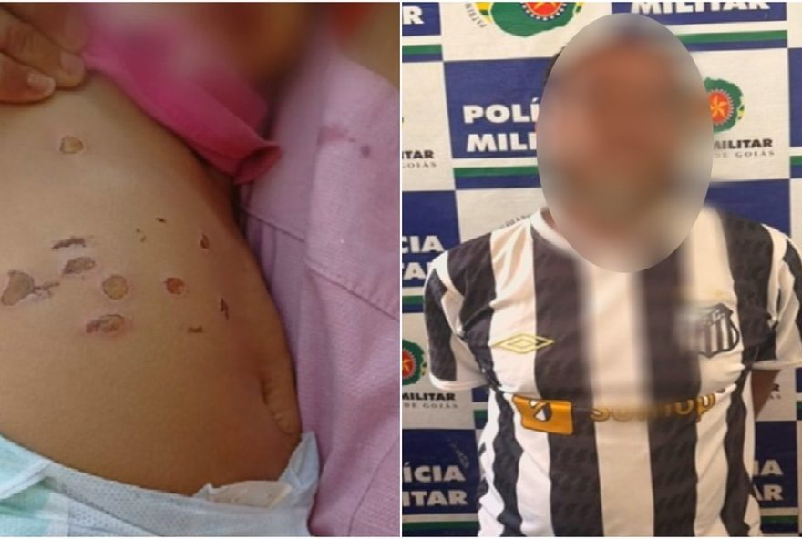 suspeito-de-agressoes-causa-queimaduras-em-bebe-de-10-meses3A-policia-investiga-caso suspeito-de-agressoes-causa-queimaduras-em-bebe-de-10-meses3A-policia-investiga-caso