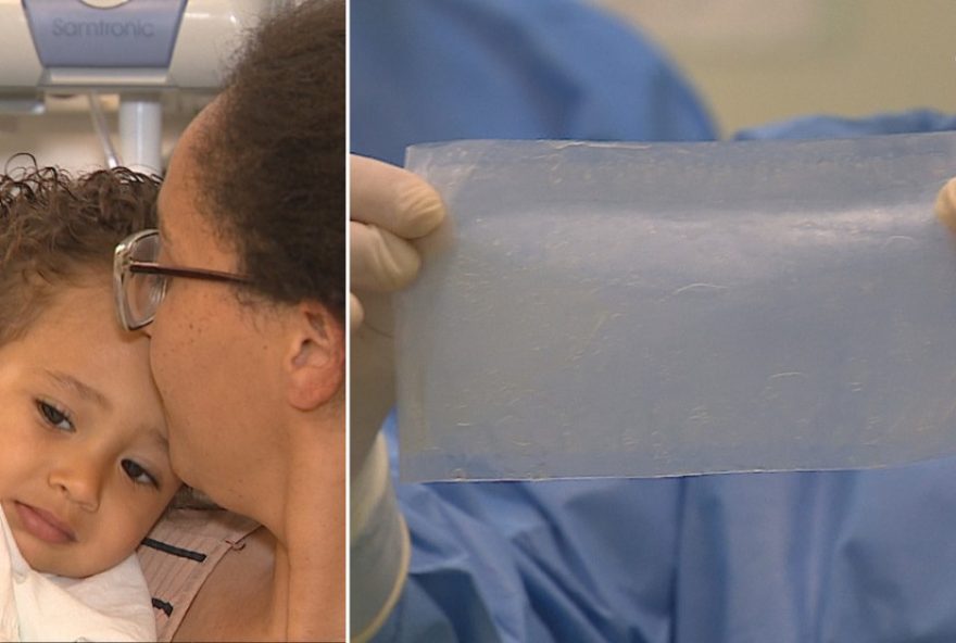 transplante-de-membrana-amniotica3A-bebe-com-queimaduras-no-rs-recebe-tratamento-inovador transplante-de-membrana-amniotica3A-bebe-com-queimaduras-no-rs-recebe-tratamento-inovador