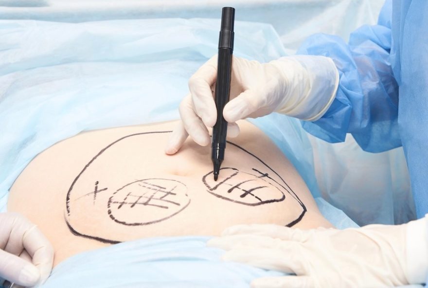 tudo-sobre-lipoaspiracao3A-indicacoes2C-cuidados-e-recomendacoes
