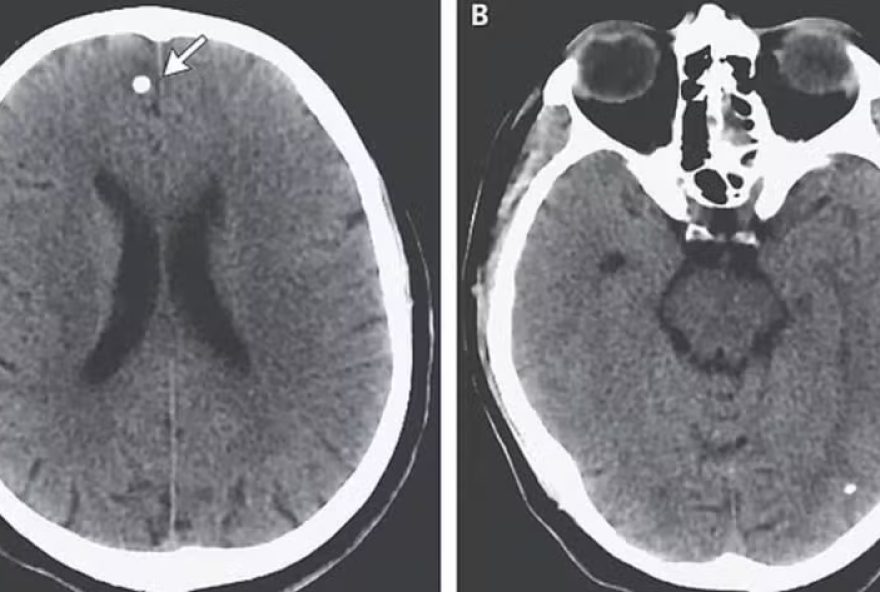 Alerta médico sobre os perigos da ingestão de ovos de tênia para perda de peso. (Foto: Reprodução)